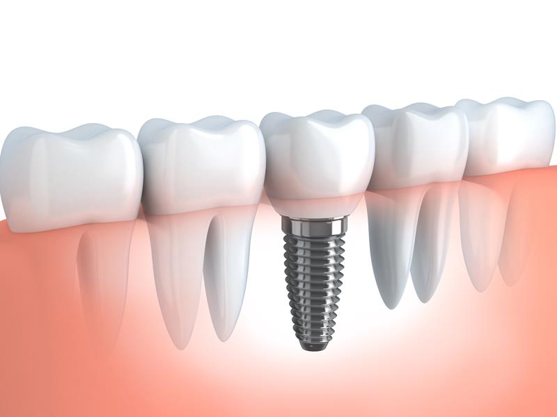 Dental Implants  Shoreline, WA 